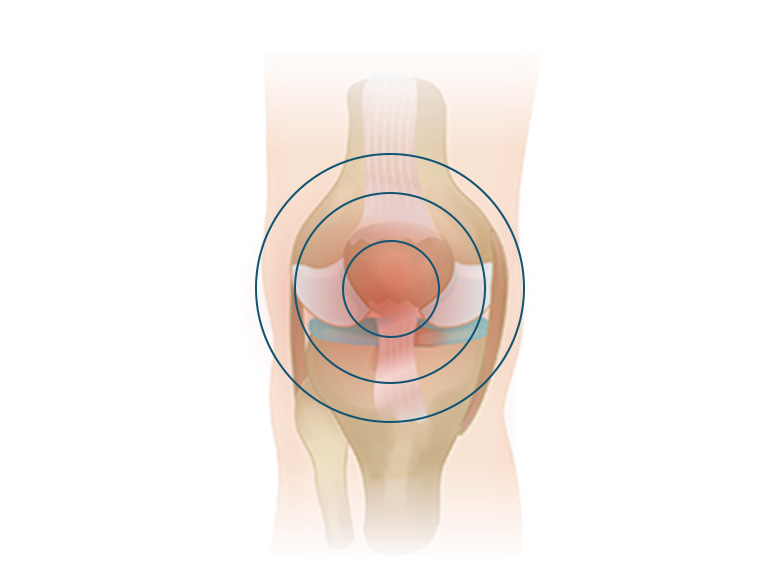 Cncrns_Cndtns-kneepain-Radiating392x294@2x.jpg