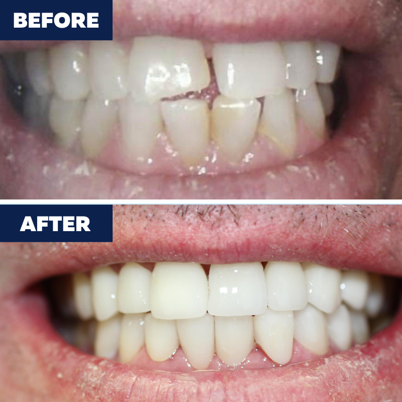 Porcelain Veneers. Call us to schedule a consultation!	(424) 317-7707 https://orthodontisttorrance.c Orthodontics of Torrance Torrance (424)201-0712