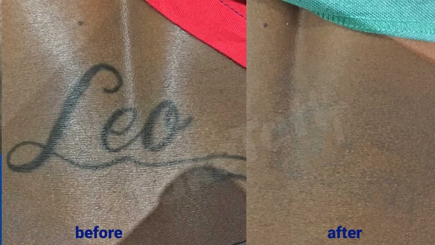 Images TakeTatt Tattoo Removal