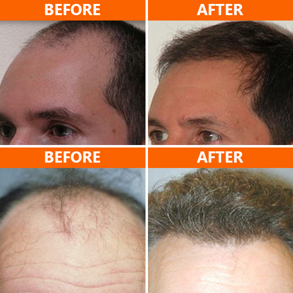 San Diego Hair MD offers the NeoGraft® hair transplant procedure, providing patients with natural-looking results! This minimally invasive hair restoration treatment extracts hair follicles from a donor area in the back of your head and implants them where thinning or balding has occurred.