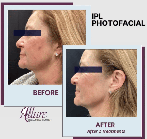 Images Allure Laser & Med Spa