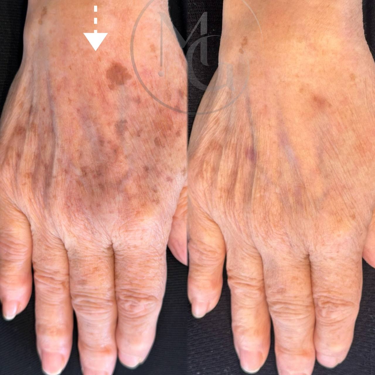 Dark spot removal in Colorado Springs by Marysol Gill, designed to improve sun spots, age spots, pigmentation, and uneven skin tone on the hands for a clearer, brighter, more rejuvenated appearance. A customized skin treatment for clients seeking visible hand rejuvenation and smoother, healthier-looking skin.
