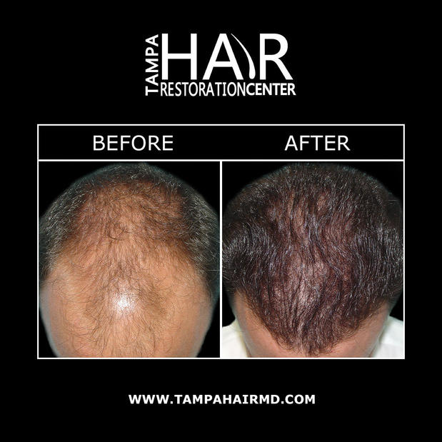 Images Tampa Hair Restoration Center