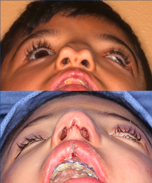 Before and After Rhinoplasty