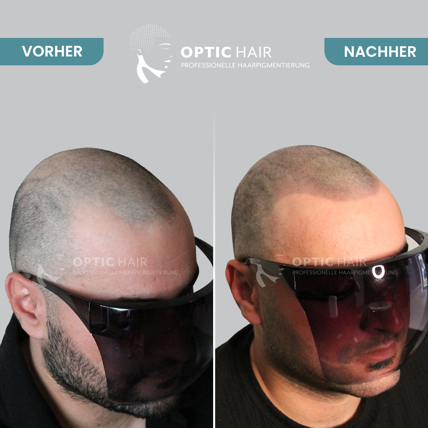Bild 8 Haarpigmentierung Köln | OpticHair in Köln