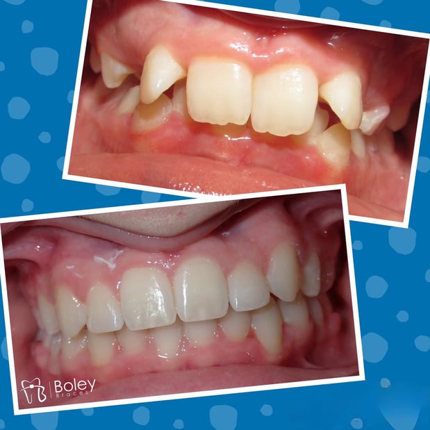 Images Boley Braces