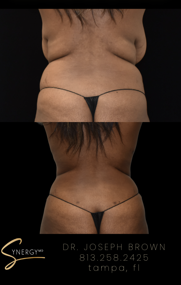 Before & After from SynergyMD Plastic Surgery | Tampa, FL