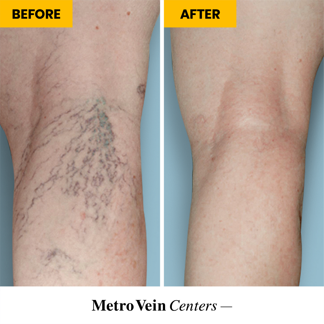 Before and after: spider vein removal results. We offer a variety of FDA-approved spider vein treatm Metro Vein Centers | Florham Park Florham Park (973)382-8771