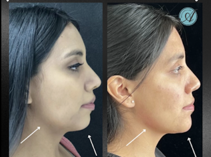 Our expert injector at Modesto Aesthetics and Laser, Liriane Schmitz Lanza, RN, BSN, used multiple syringe of face filler to balance this patients chin and jawline. Give us a call for more information about this service.