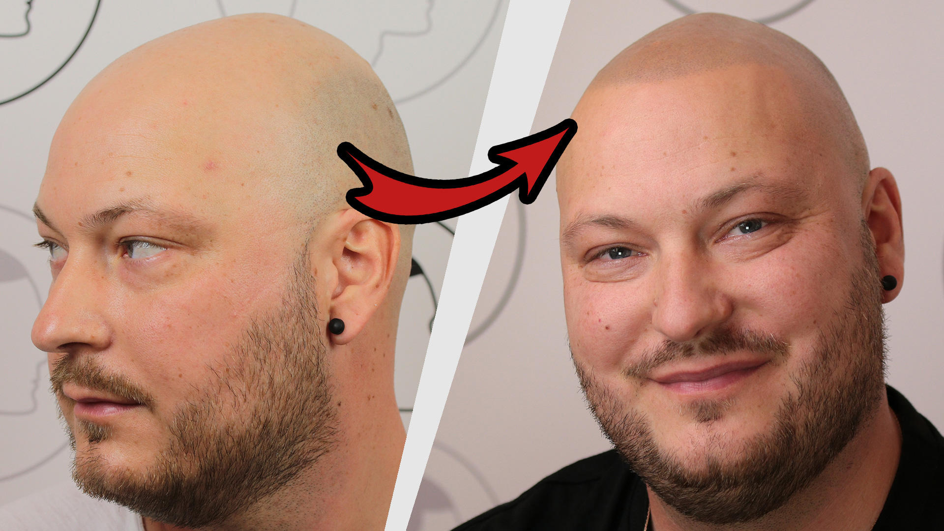 Bild 2 Haarpigmentierung | Modern Hair Loss Solution in Berlin