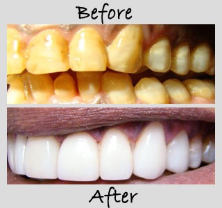 Before-and-after smile makeover highlighting a noticeable improvement in the appearance, color, and  