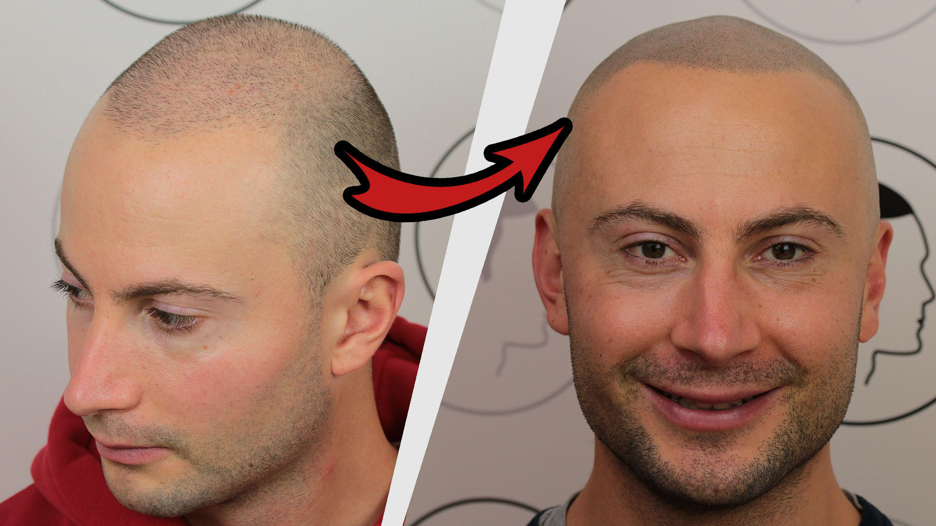 Kundenfoto 3 Haarpigmentierung | Modern Hair Loss Solution