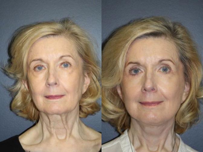 Before & After from O'Brien Plastic Surgery: Kevin M. O'Brien, MD | Birmingham, AL