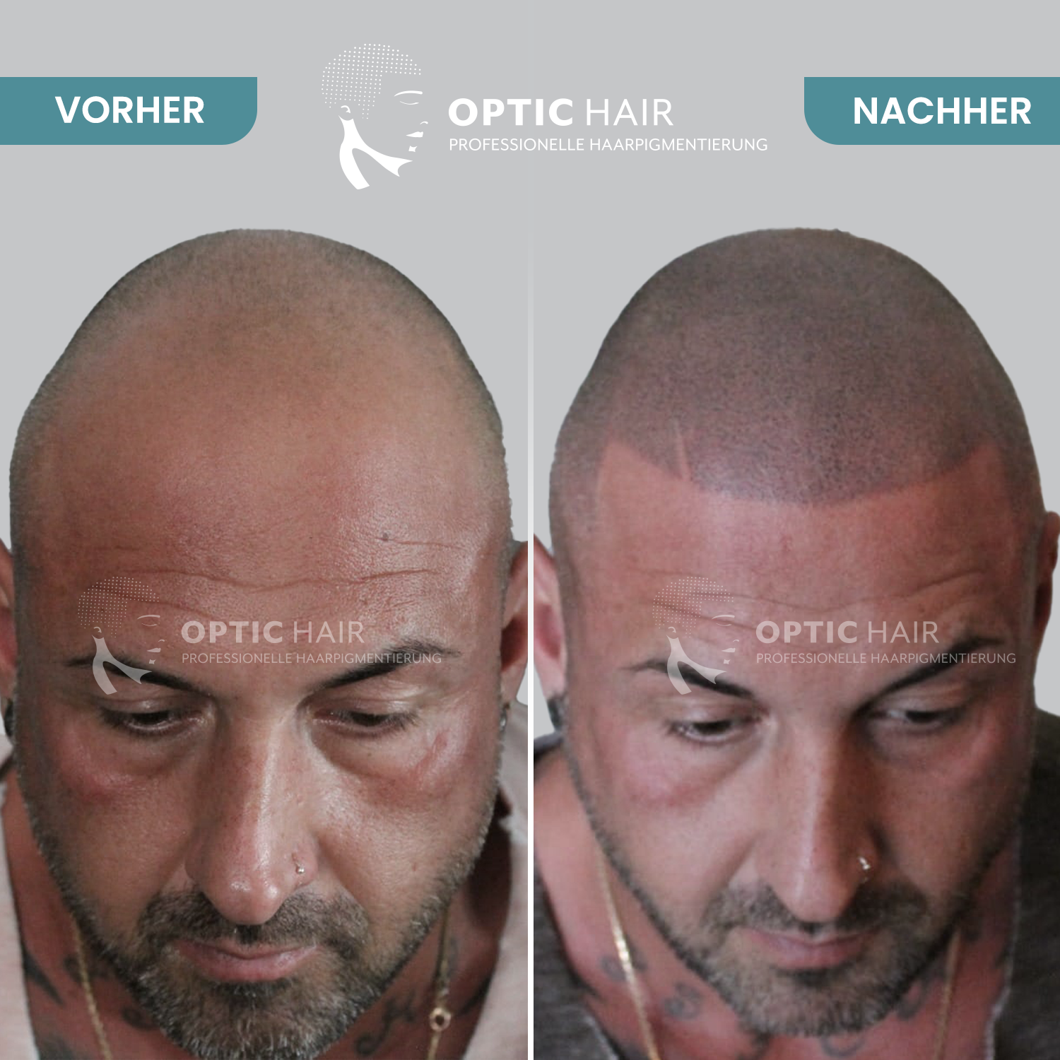 Kundenbild groß 28 Haarpigmentierung Köln | OpticHair