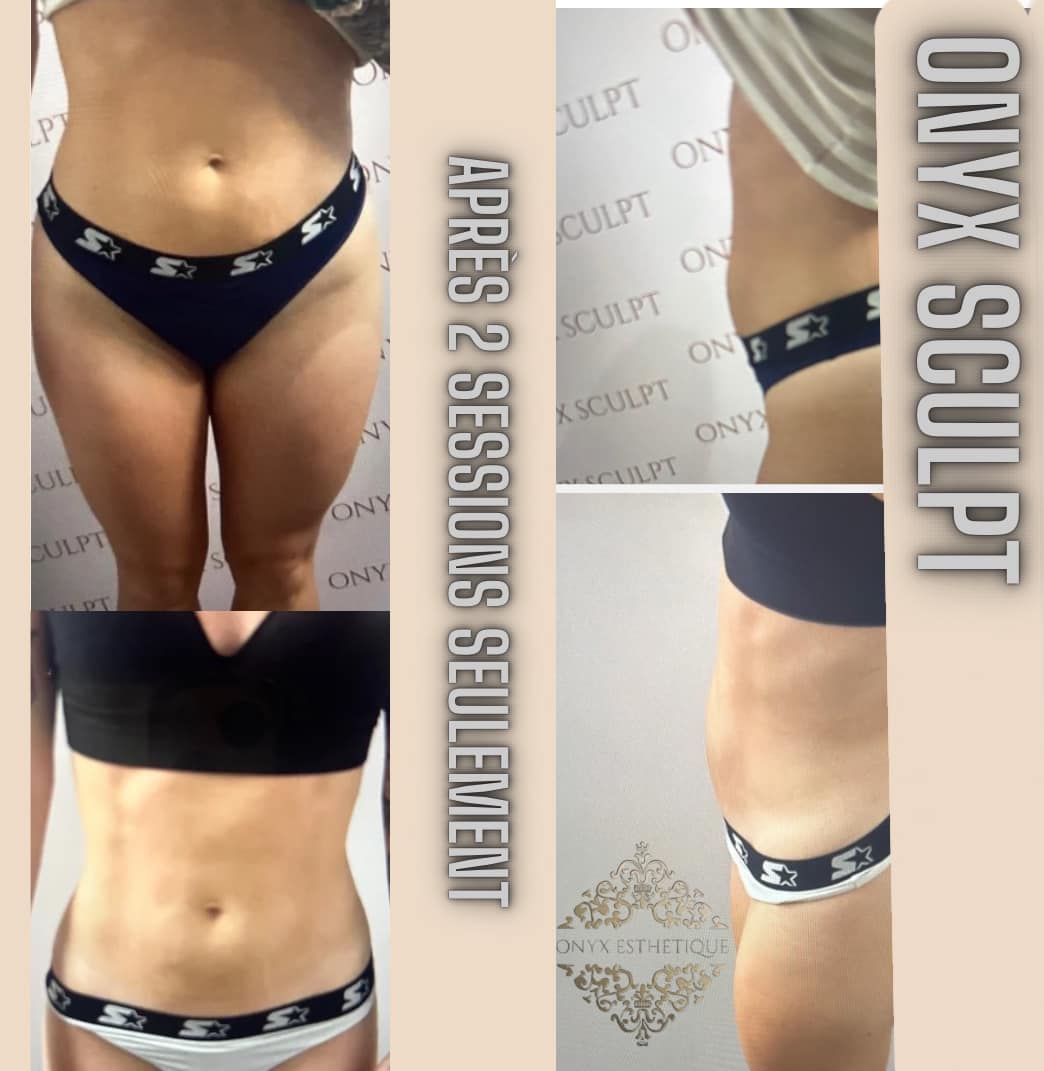 Images Onyx Esthétique - Soins esthétiques, Soins de la peau, Laser Cynosure Gatineau