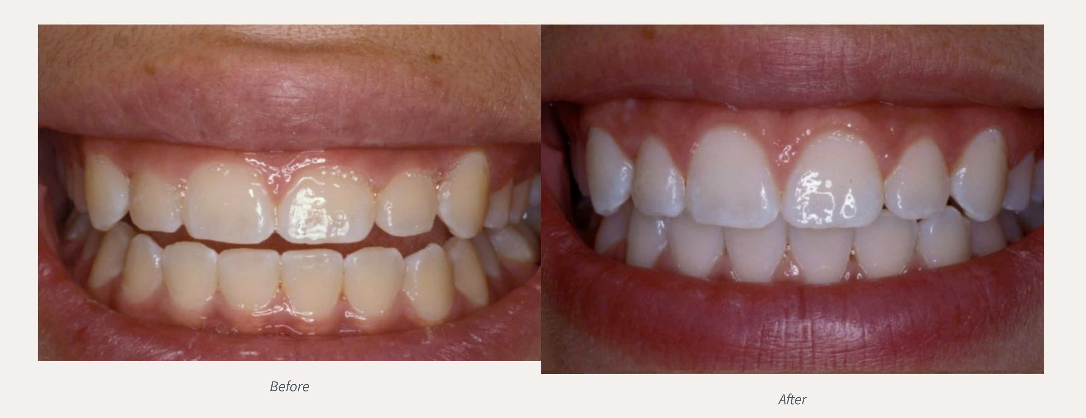 Teethe Whitening  Before & After fromAdvanced Dental Care | Valdosta, GA