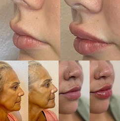 Before-and-after lip enhancement and facial balancing results.