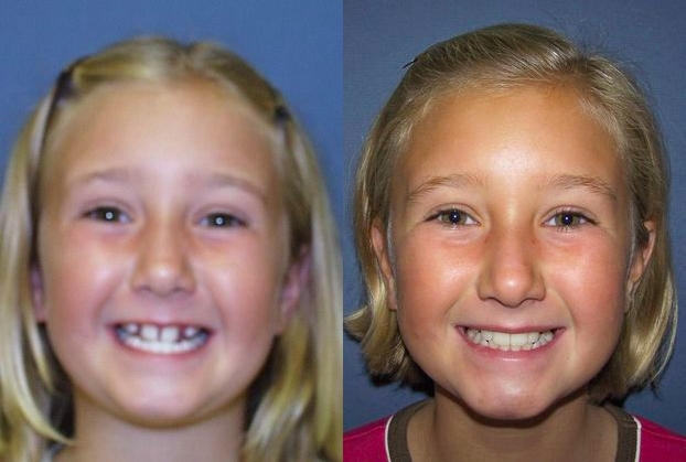Before & After from Kellyn Hodges Orthodontics | Montgomeryville, PA