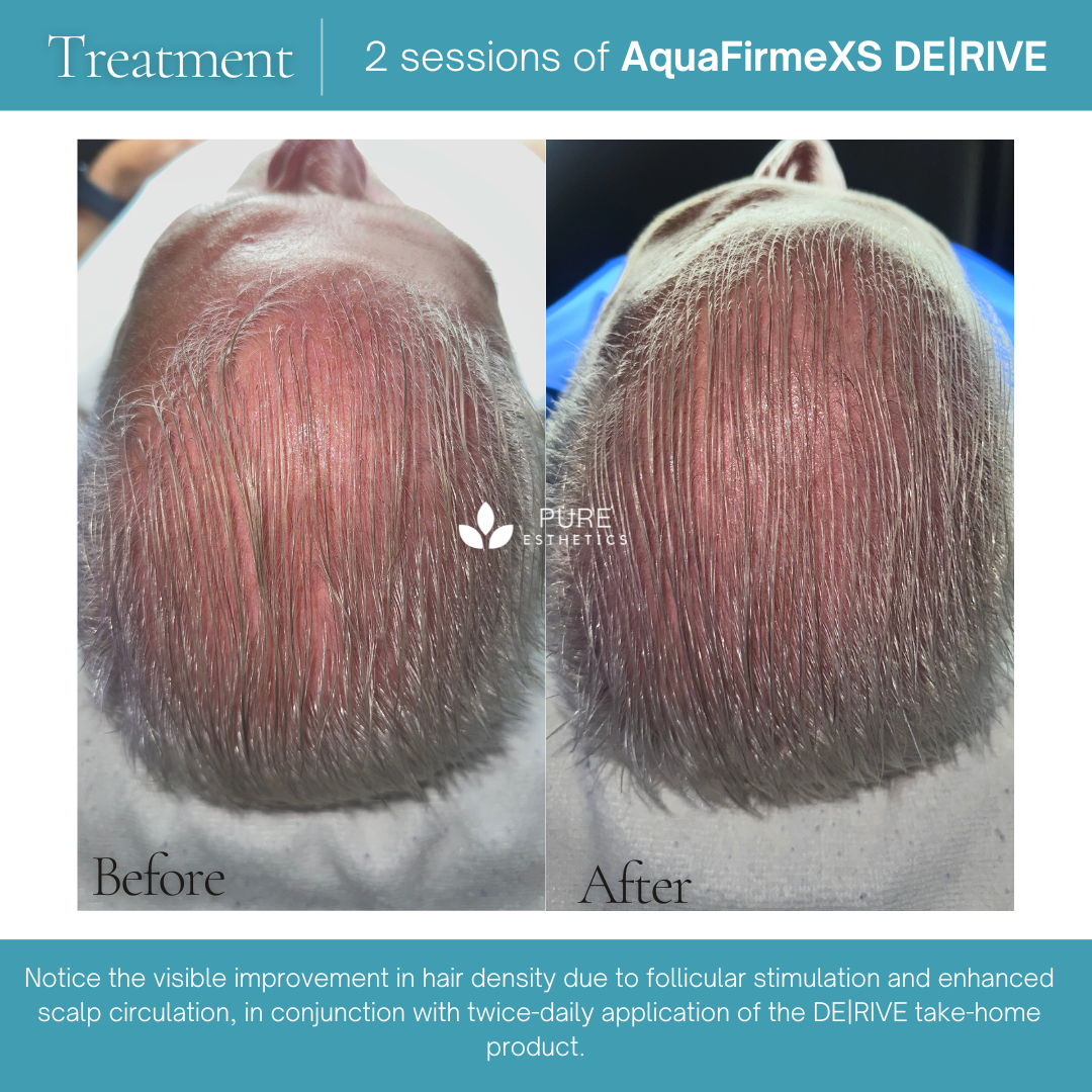 Before-and-after treatment results from Pureesthetics show the top of a client&rsquo;s scalp before treatment and after 2 sessions of AquaFirmeXS DERIVE. The comparison highlights visible improvement in hair density and scalp appearance, reflecting the hair and scalp rejuvenation results featured on the Pureesthetics results page in Birmingham, Alabama.