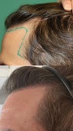 Images BKS Hair Restoration