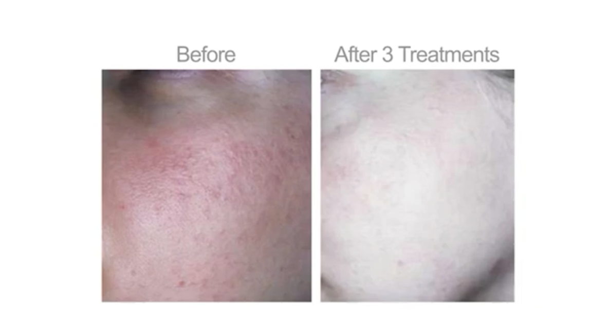 before and after Lumecca IPL