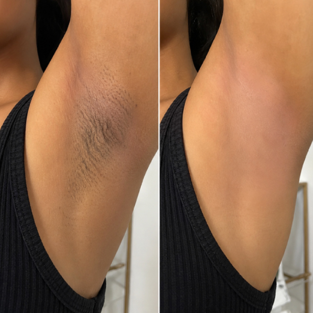 Professional underarm waxing at Avissa Salon in Ann Arbor delivers smooth, long-lasting results by r 