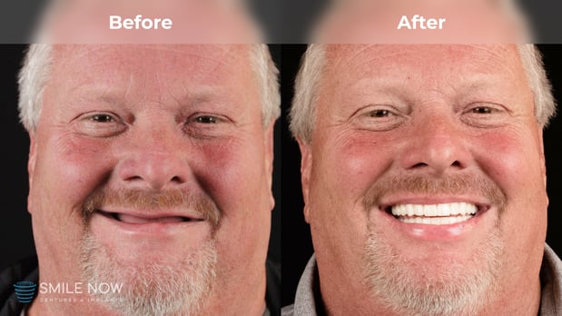 Images Smile Now Tacoma Dentures and Implants