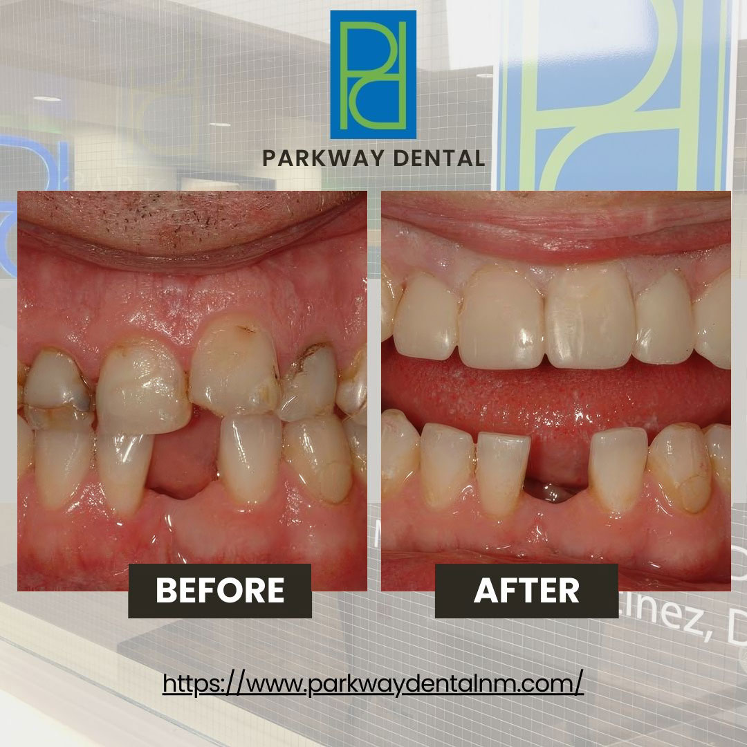 Before and after at Parkway Dental: Michael D Haight, DDS | Albuquerque, NM Parkway Dental: Michael D Haight, DDS Albuquerque (505)298-7479