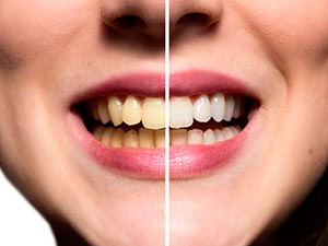 Kundenbild groß 4 Zahnarzt Dr. Birgit von Sachsen-Coburg | Zahnaufhellung | München
