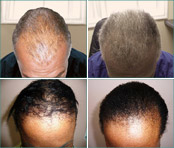 Images Hair Loss Control Clinic (HLCC) Latham