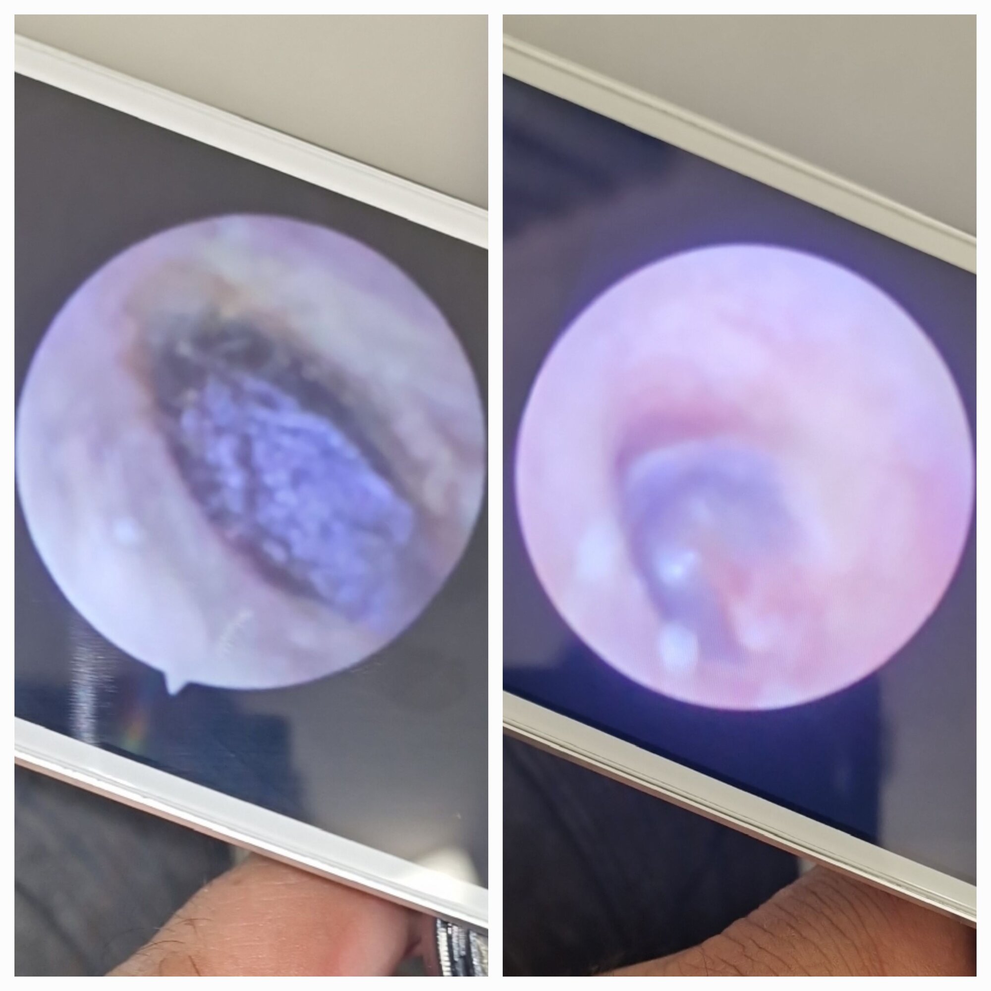 Images MW Ear Wax Removal