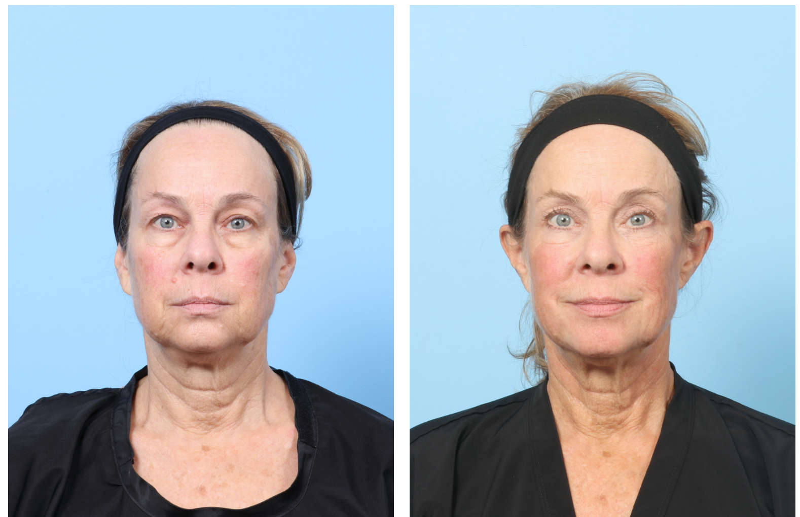 Dr. Drew Davis Sacramento Eyelid Surgery 