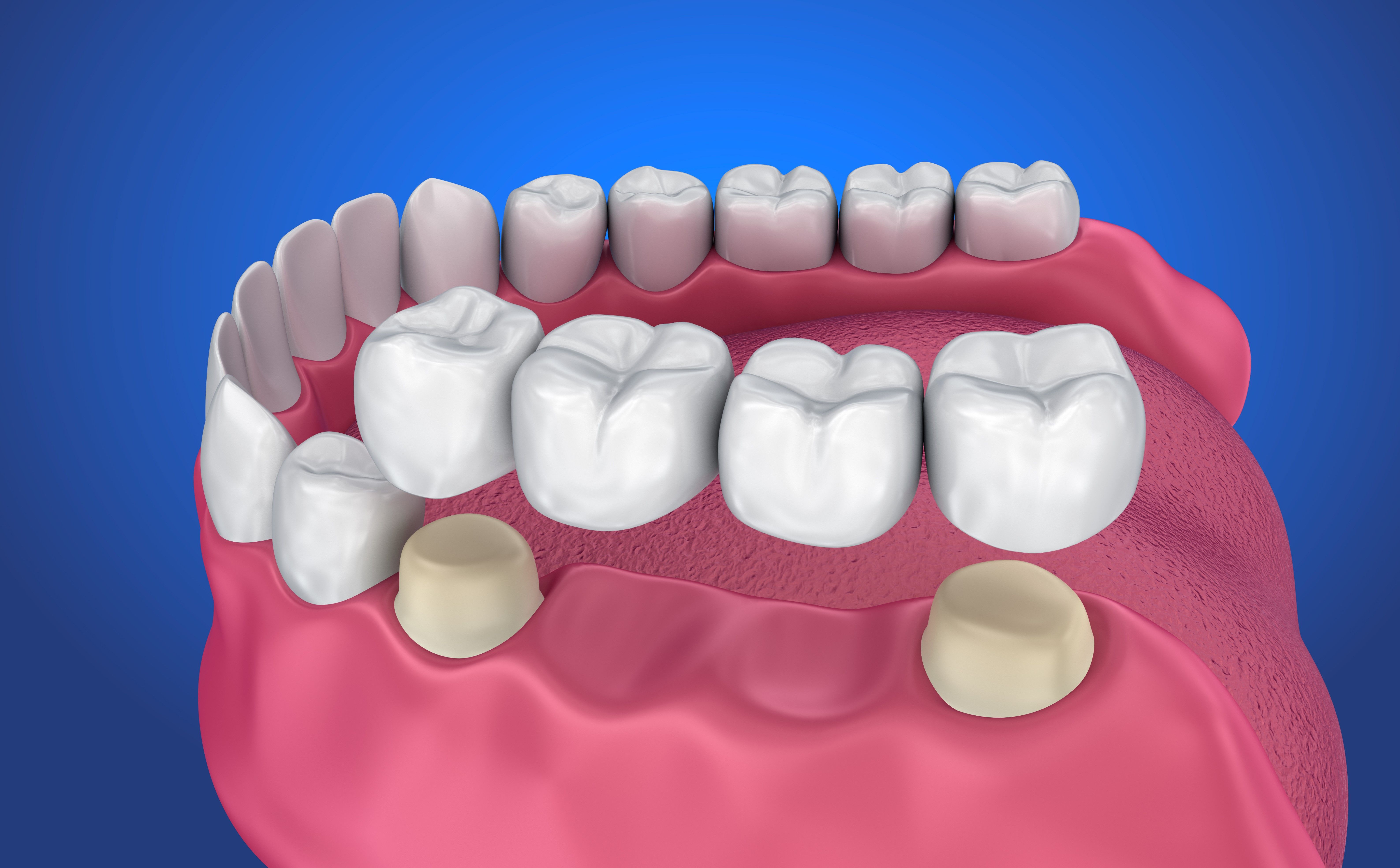 как выглядят мосты в стоматологии