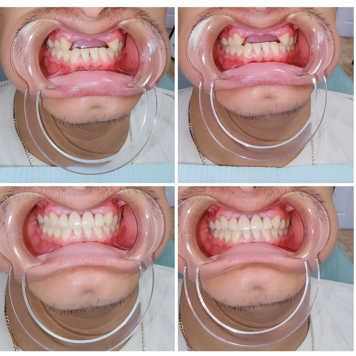 Marcos Torres Dental Esthetics-Frenos Invisibles