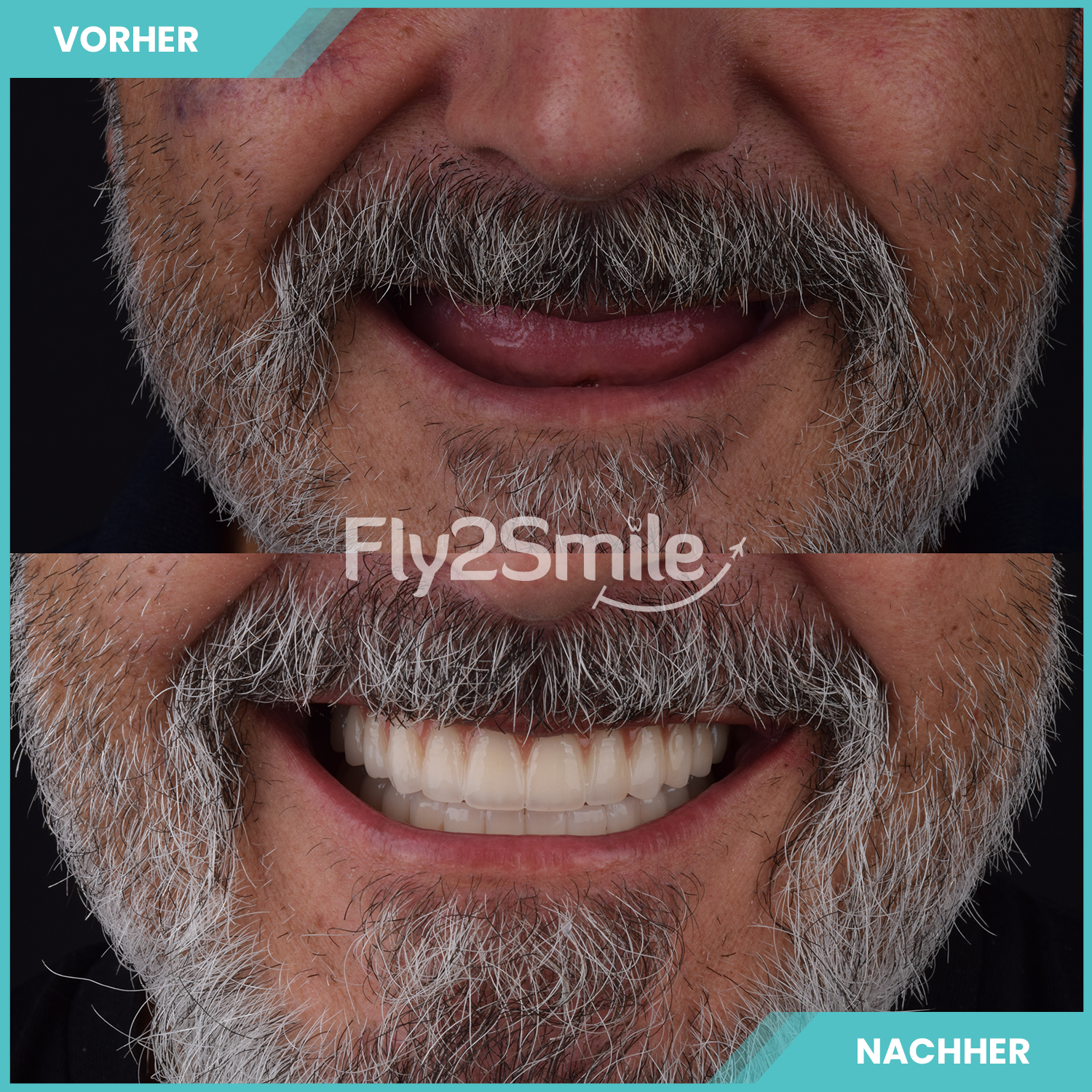 Bild 15 Veneers & Zahnimplantate – Zähne machen lassen in der Türkei mit Fly2Smile in Berlin