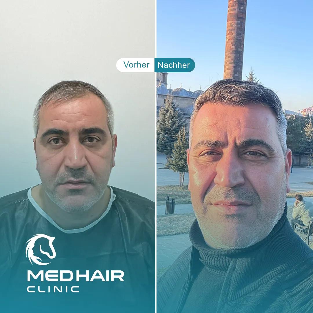 MedHair Clinic | Haartransplantationen in der Türkei Istanbul, Höninger Weg 176 in Rodenkirchen
