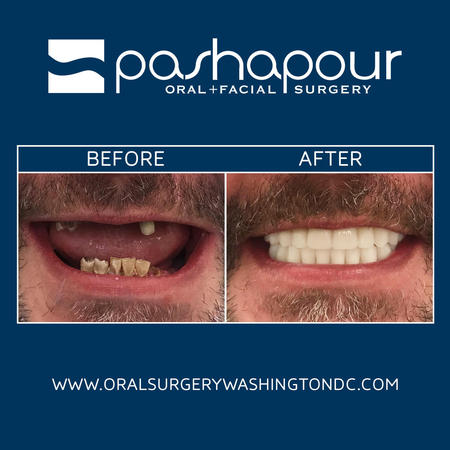 Full mouth reconstruction offers transformative results. This patient had been missing teeth for most of his adult life. We were able to bone graft the maxillary ridge & place hybrid dental implants during his procedure.