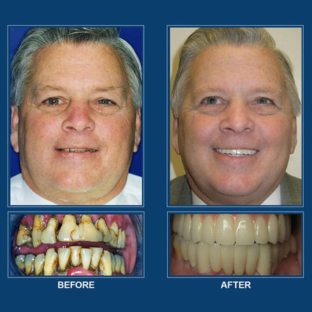 Our oral surgeons provide a number of oral and maxillofacial options, including dental implants, wisdom teeth extraction, and bone grafts. We also offer dental Implants, which are inserted into the jawbone as a prosthetic. After inserting dental implants, a dental crown is then placed for a beautiful, healthy smile. Dental implants are an alternative to dentures, allowing a patient to have teeth that look, feel, and function like natural teeth.