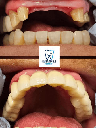 Images Eversmile Dentist