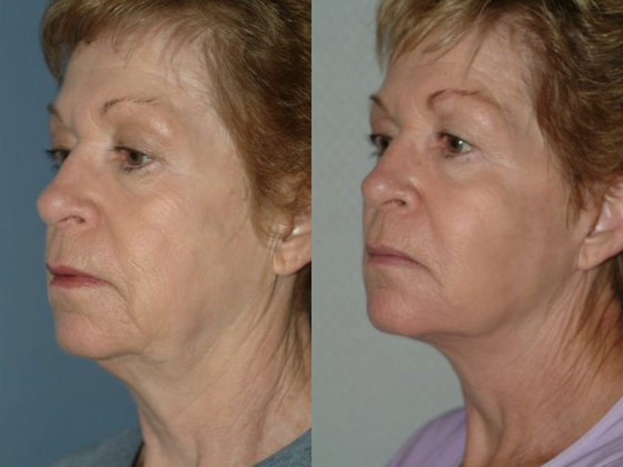Before & After Results at The Center for Cosmetic Medicine | Decatur, IL