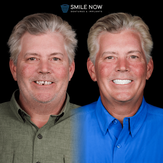Images Smile Now Milwaukee Dentures and Implants
