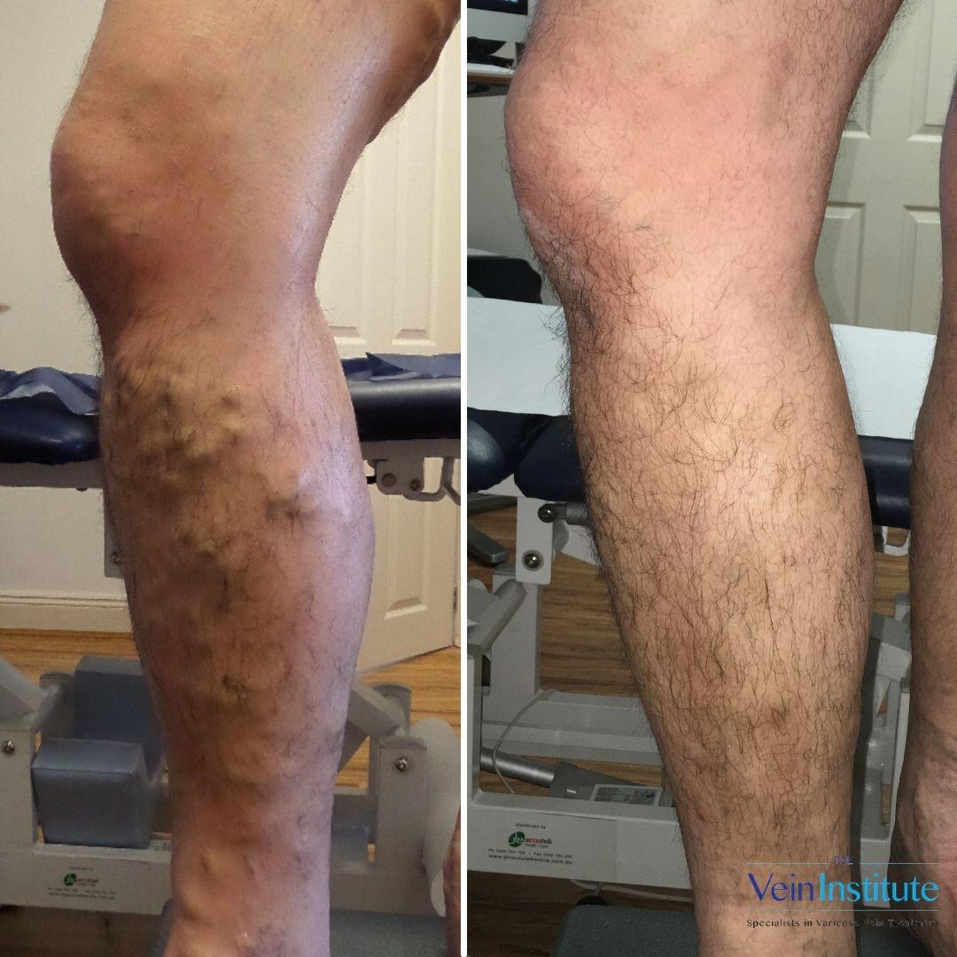 Images The Vein Institute Sydney - Varicose Vein Specialists