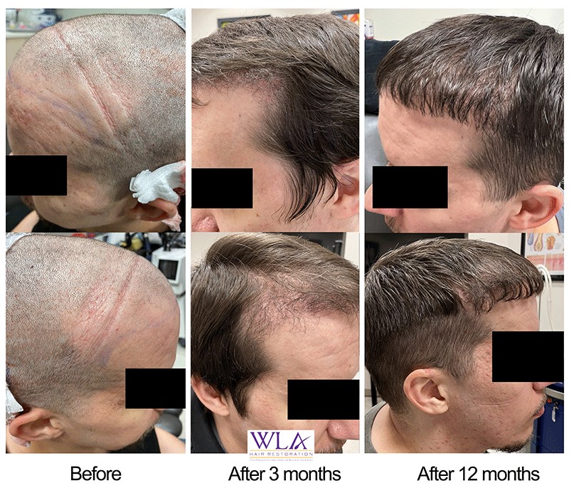Images West LA Hair Restoration