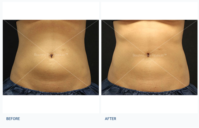 Before and After | CoolSculpting at Dermatology & Laser Surgery Center