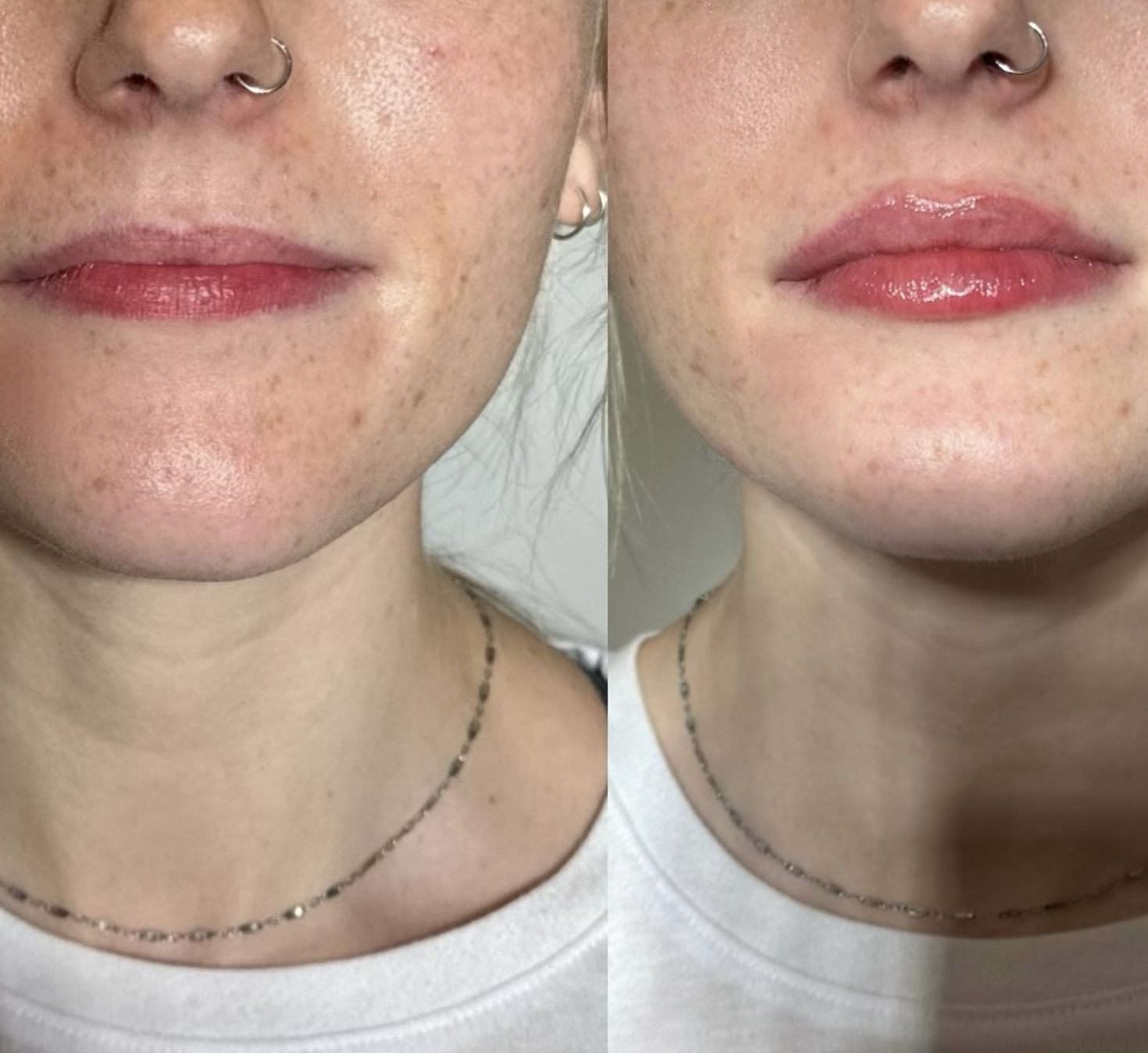 before and after microneedling