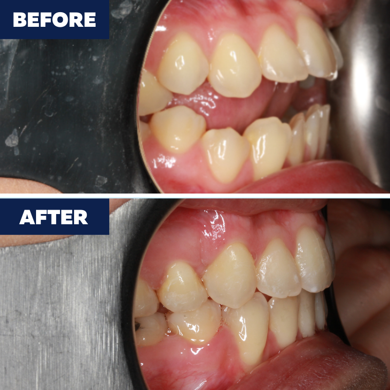 Open bite treated braces 24 months. Call us to schedule a consultation!	(424) 317-7707 https://ortho Orthodontics of Torrance Torrance (424)201-0712