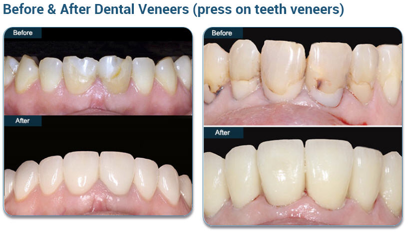 Before & After Dental Veneers (press on teeth veneers)