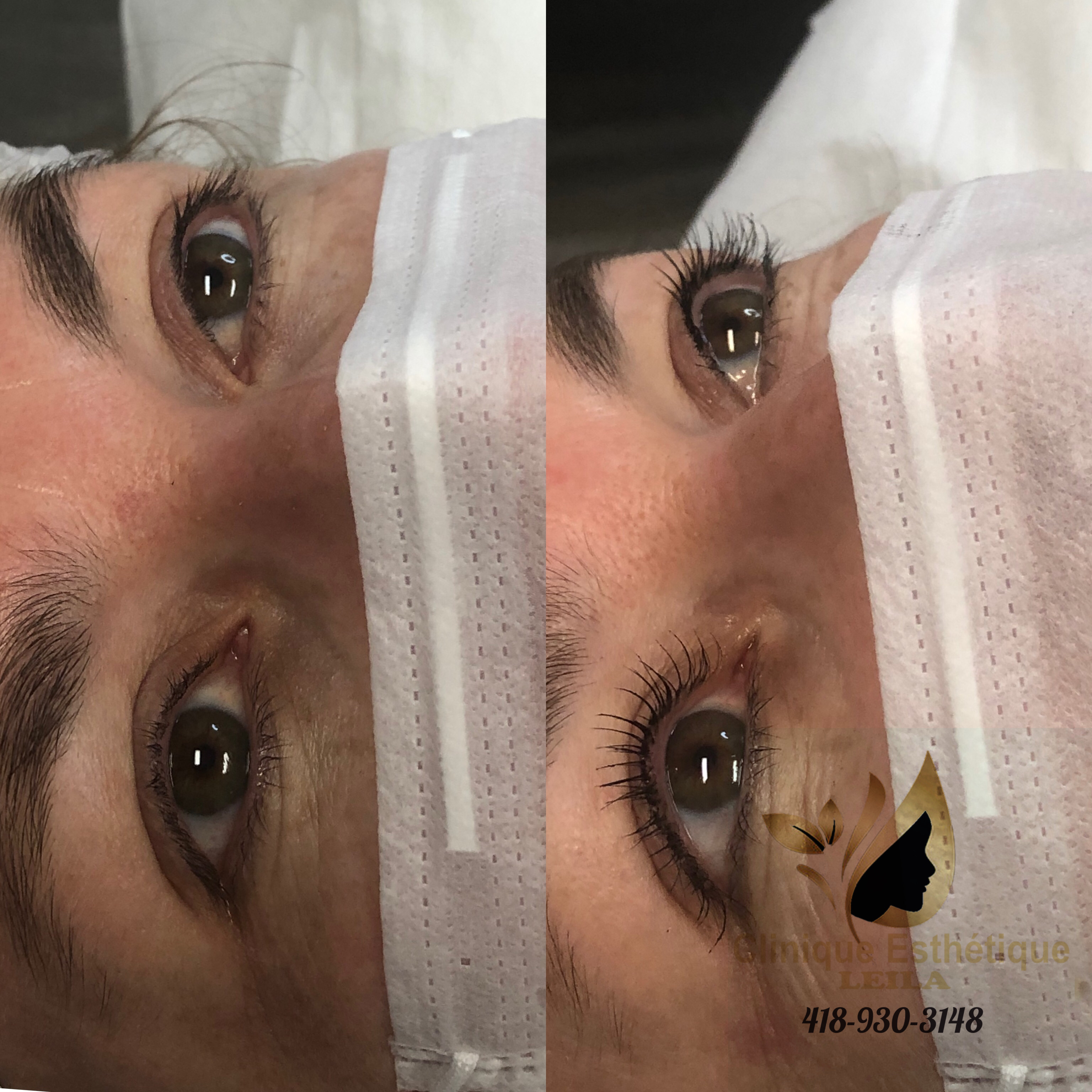Images Clinique d'Esthétique Leila - Hydrafacial, Microblading, Épilation Laser Sainte-Foy