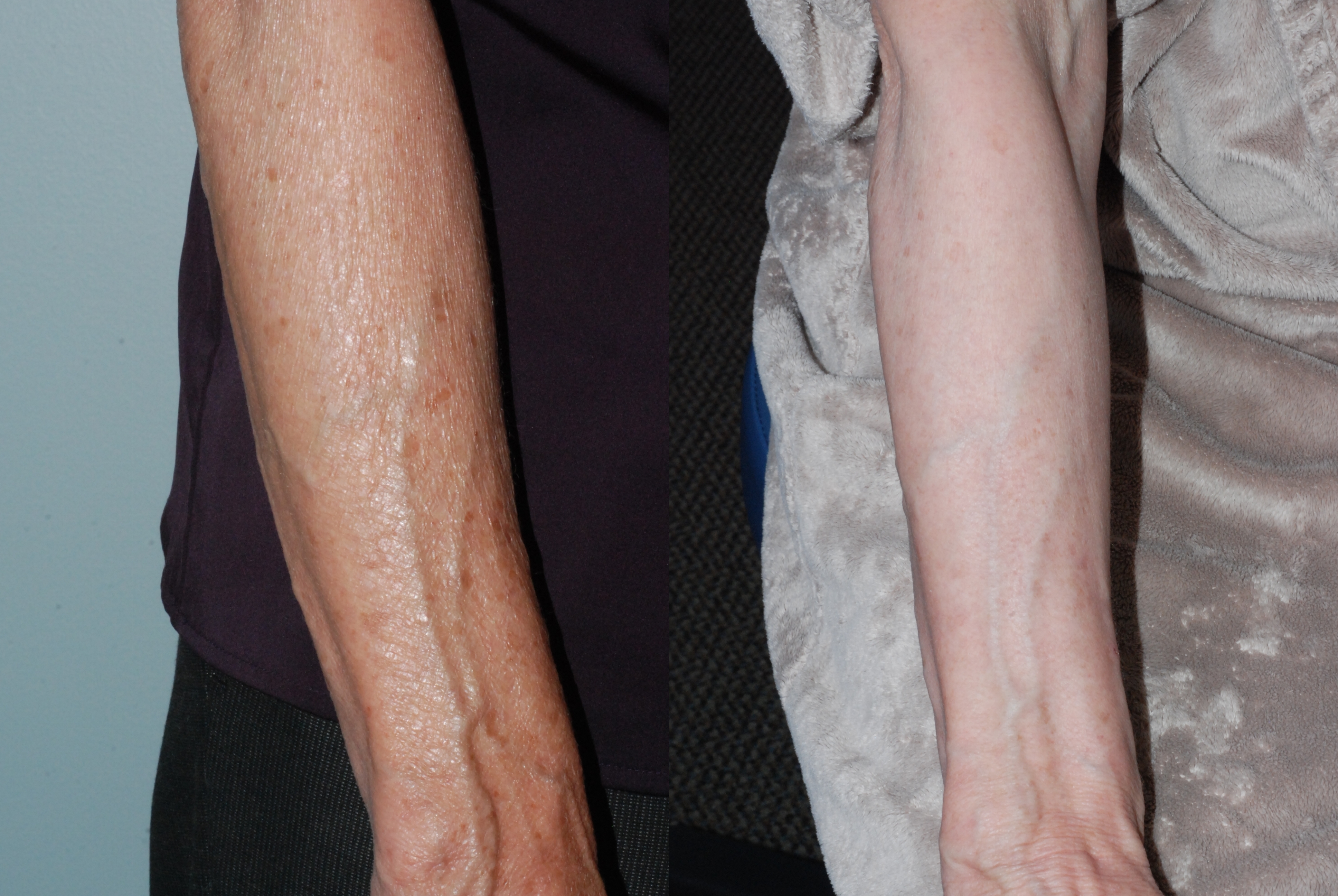 Single treatment of arms with Fraxel Dual Laser