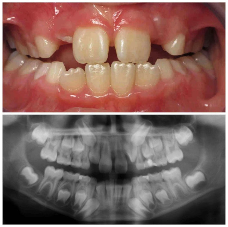 Before & After from Karski & Spokane Orthodontics | Seven Fields, PA